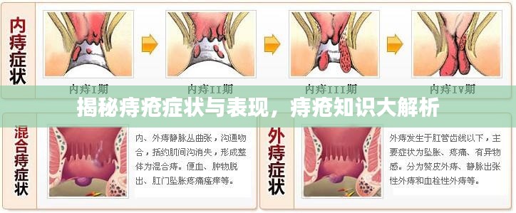 揭秘痔疮症状与表现，痔疮知识大解析