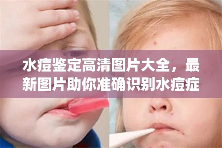 水痘鉴定高清图片大全，最新图片助你准确识别水痘症状