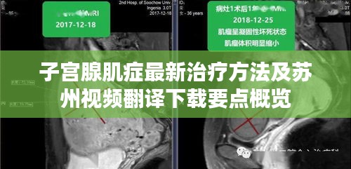 子宫腺肌症最新治疗方法及苏州视频翻译下载要点概览